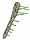  – One of the Sigma Surgical bone plates manu&shy;factured for its Sorath Ortho brand. The plate demonstrates not only the number of holes required, but also the plane orien&shy;tation, posi&shy;tioning and pre&shy;ci&shy;sion required<br /><em>Source: Sigma Surgical</em>